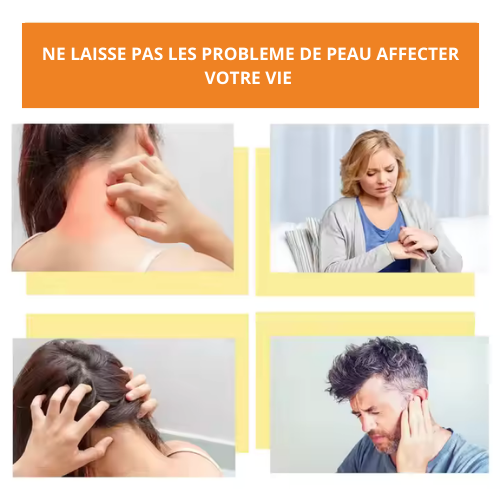 La crème de traitement du psoriasis au venin d'abeille OVILDS®